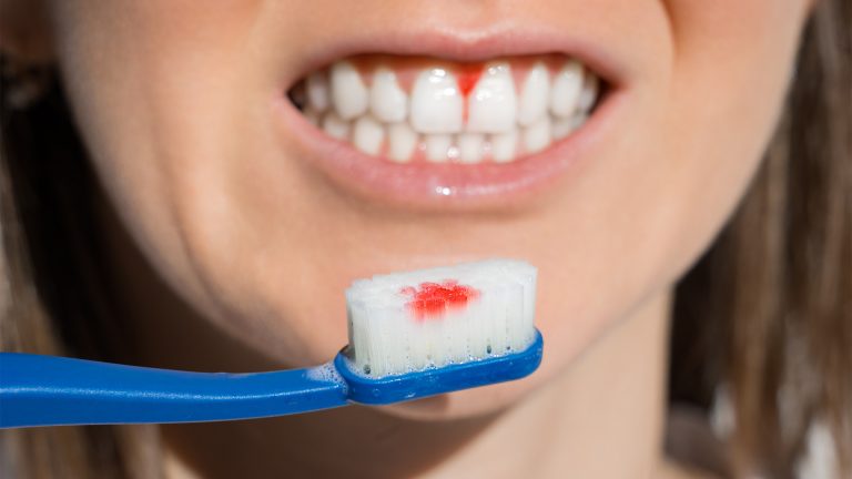 Bloedend tandvlees zichtbaar op tandenborstel – symptoom van tandvleesontsteking